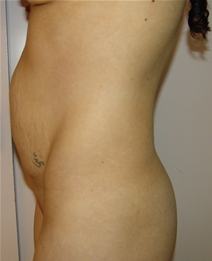 Tummy Tuck Before Photo by Moneer Jaibaji, MD; Coronado, CA - Case 21168