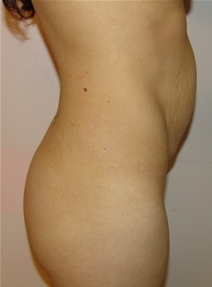 Tummy Tuck Before Photo by Moneer Jaibaji, MD; Coronado, CA - Case 21168