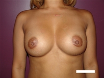 Breast Augmentation After Photo by Moneer Jaibaji, MD; Coronado, CA - Case 21177