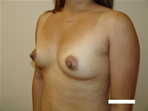 Breast Augmentation Before Photo by Moneer Jaibaji, MD; Coronado, CA - Case 21177