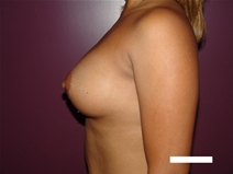 Breast Augmentation After Photo by Moneer Jaibaji, MD; Coronado, CA - Case 21177