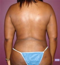 Liposuction After Photo by Moneer Jaibaji, MD; Coronado, CA - Case 21232