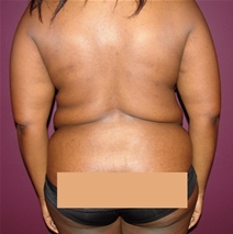 Liposuction Before Photo by Moneer Jaibaji, MD; Coronado, CA - Case 21232