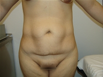 Tummy Tuck Before Photo by Moneer Jaibaji, MD; Coronado, CA - Case 21270
