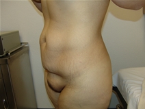 Tummy Tuck Before Photo by Moneer Jaibaji, MD; Coronado, CA - Case 21270
