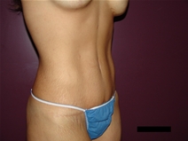 Tummy Tuck After Photo by Moneer Jaibaji, MD; Coronado, CA - Case 21270