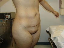 Tummy Tuck Before Photo by Moneer Jaibaji, MD; Coronado, CA - Case 21270