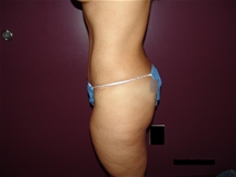 Tummy Tuck After Photo by Moneer Jaibaji, MD; Coronado, CA - Case 21270