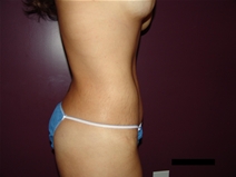 Tummy Tuck After Photo by Moneer Jaibaji, MD; Coronado, CA - Case 21270