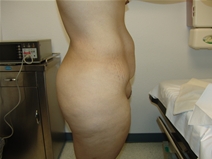 Tummy Tuck Before Photo by Moneer Jaibaji, MD; Coronado, CA - Case 21270
