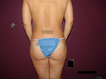 Tummy Tuck After Photo by Moneer Jaibaji, MD; Coronado, CA - Case 21270