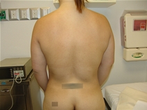 Tummy Tuck Before Photo by Moneer Jaibaji, MD; Coronado, CA - Case 21270
