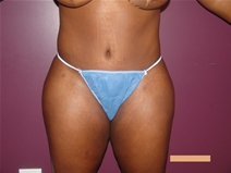 Tummy Tuck After Photo by Moneer Jaibaji, MD; Coronado, CA - Case 21277
