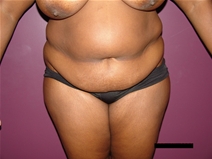Tummy Tuck Before Photo by Moneer Jaibaji, MD; Coronado, CA - Case 21277
