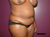 Tummy Tuck Before Photo by Moneer Jaibaji, MD; Coronado, CA - Case 21277