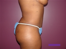 Tummy Tuck After Photo by Moneer Jaibaji, MD; Coronado, CA - Case 21277