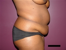 Tummy Tuck Before Photo by Moneer Jaibaji, MD; Coronado, CA - Case 21277