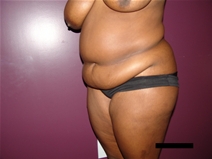 Tummy Tuck Before Photo by Moneer Jaibaji, MD; Coronado, CA - Case 21277