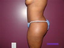 Tummy Tuck After Photo by Moneer Jaibaji, MD; Coronado, CA - Case 21277