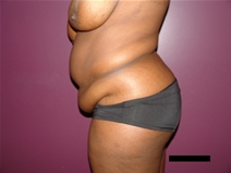 Tummy Tuck Before Photo by Moneer Jaibaji, MD; Coronado, CA - Case 21277