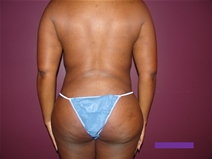 Tummy Tuck After Photo by Moneer Jaibaji, MD; Coronado, CA - Case 21277