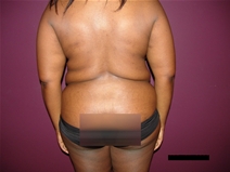 Tummy Tuck Before Photo by Moneer Jaibaji, MD; Coronado, CA - Case 21277