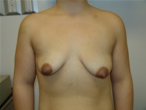 Breast Augmentation Before Photo by Moneer Jaibaji, MD; Coronado, CA - Case 21324