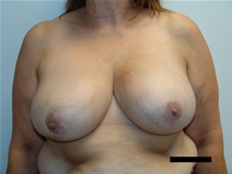 Breast Reduction After Photo by Moneer Jaibaji, MD; Coronado, CA - Case 21335