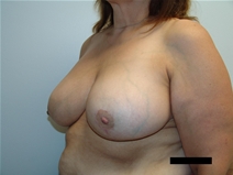 Breast Reduction After Photo by Moneer Jaibaji, MD; Coronado, CA - Case 21335