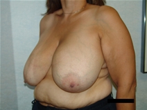 Breast Reduction Before Photo by Moneer Jaibaji, MD; Coronado, CA - Case 21335