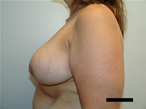 Breast Reduction After Photo by Moneer Jaibaji, MD; Coronado, CA - Case 21335