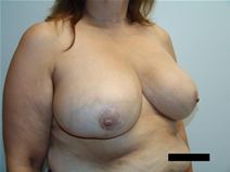 Breast Reduction After Photo by Moneer Jaibaji, MD; Coronado, CA - Case 21335