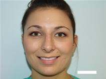 Rhinoplasty After Photo by Moneer Jaibaji, MD; Coronado, CA - Case 21463