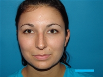 Rhinoplasty Before Photo by Moneer Jaibaji, MD; Coronado, CA - Case 21463