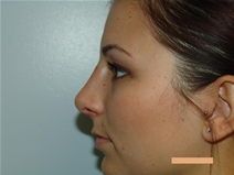Rhinoplasty After Photo by Moneer Jaibaji, MD; Coronado, CA - Case 21463