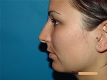 Rhinoplasty Before Photo by Moneer Jaibaji, MD; Coronado, CA - Case 21463