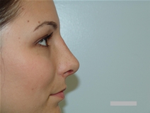 Rhinoplasty After Photo by Moneer Jaibaji, MD; Coronado, CA - Case 21463