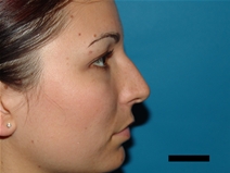 Rhinoplasty Before Photo by Moneer Jaibaji, MD; Coronado, CA - Case 21463