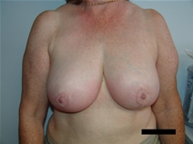 Breast Reduction After Photo by Moneer Jaibaji, MD; Coronado, CA - Case 21464