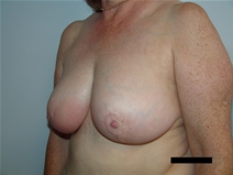 Breast Reduction After Photo by Moneer Jaibaji, MD; Coronado, CA - Case 21464