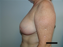 Breast Reduction After Photo by Moneer Jaibaji, MD; Coronado, CA - Case 21464