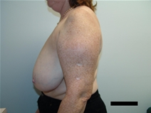 Breast Reduction Before Photo by Moneer Jaibaji, MD; Coronado, CA - Case 21464
