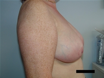 Breast Reduction After Photo by Moneer Jaibaji, MD; Coronado, CA - Case 21464