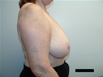 Breast Reduction Before Photo by Moneer Jaibaji, MD; Coronado, CA - Case 21464
