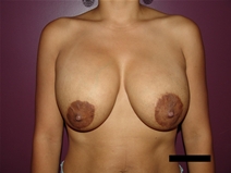 Breast Lift Before Photo by Moneer Jaibaji, MD; Coronado, CA - Case 21465