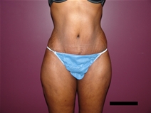Tummy Tuck After Photo by Moneer Jaibaji, MD; Coronado, CA - Case 21625