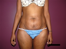 Tummy Tuck Before Photo by Moneer Jaibaji, MD; Coronado, CA - Case 21625