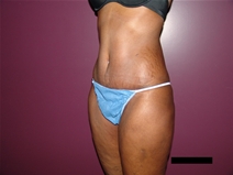 Tummy Tuck After Photo by Moneer Jaibaji, MD; Coronado, CA - Case 21625