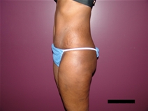 Tummy Tuck After Photo by Moneer Jaibaji, MD; Coronado, CA - Case 21625