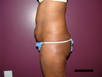 Tummy Tuck Before Photo by Moneer Jaibaji, MD; Coronado, CA - Case 21625